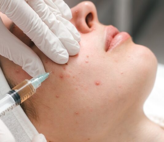 What Do You Need To Know About The Acne Treatment? Acne Treatment